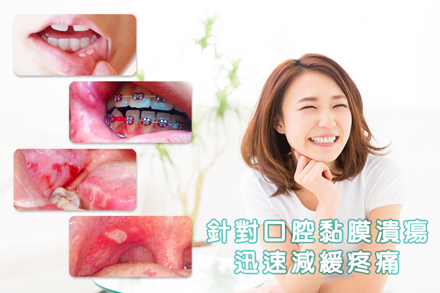 口腔潰瘍照護-速口舒-迅速減緩嘴破疼痛