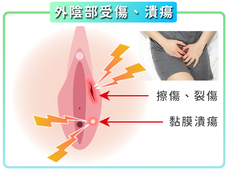 速膜舒-黏膜液體繃帶-適應症-外陰部受傷潰瘍